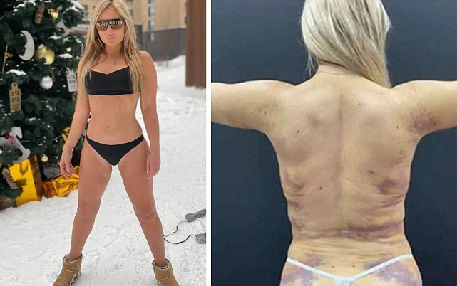 Дана Борисова показала изуродованное липосакцией тело